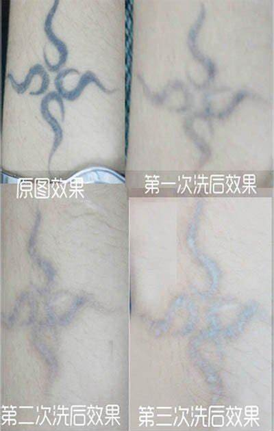 激光洗纹身