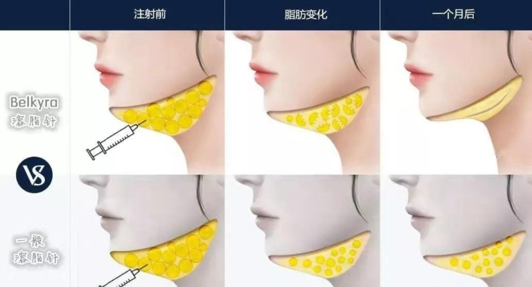 双下巴、腰腹赘肉悄悄消失？溶脂针效果太震撼！